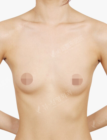 Breast Augmentation (4 Months) — Before