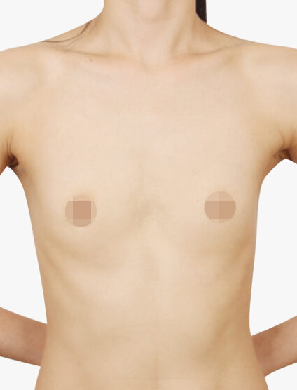 Breast Augmentation (4 Months) — Before