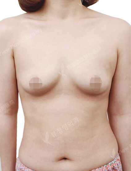 Breast Augmentation (6 Months) — Before