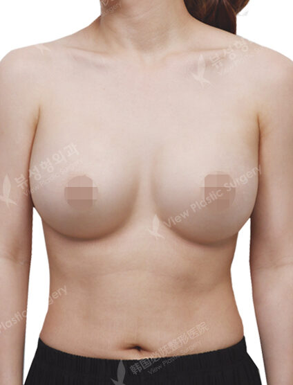 Breast Augmentation (6 Months) — After