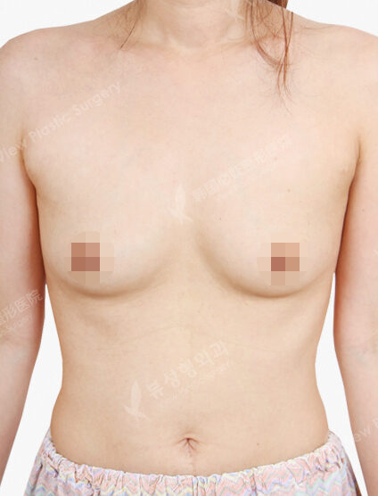 Breast Augmentation (3 Months) — Before