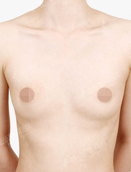 Breast Augmentation (4 Months) — Before