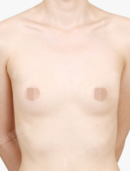 Breast Augmentation(4 Months) — Before