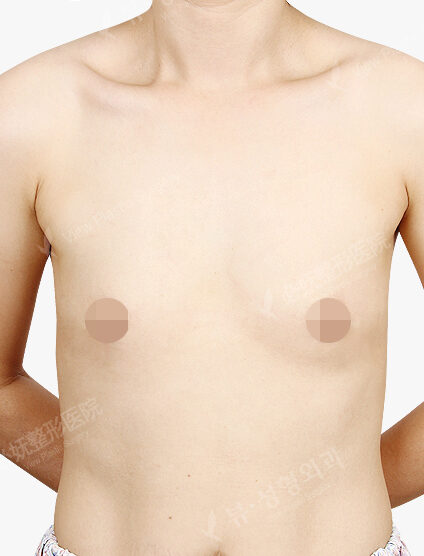 Breast Augmentation(3 Months) — Before