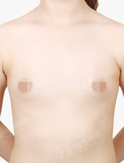 Breast Augmentation (4 Months) — Before
