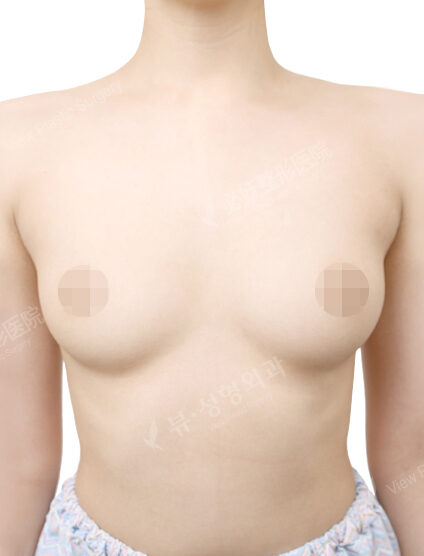 Breast Augmentation (5 Months) — Before