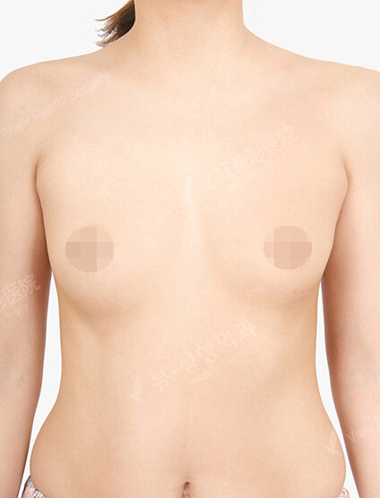 Breast Augmentation (11 Months) — Before