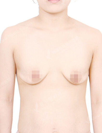 Breast Augmentation (13 Months) — Before