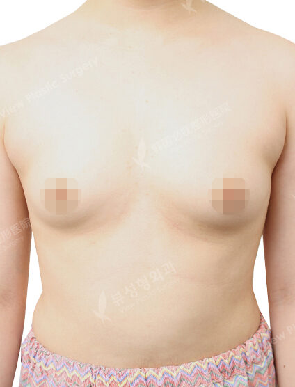 Breast Augmentation Tear Drop (6 Months) — Before