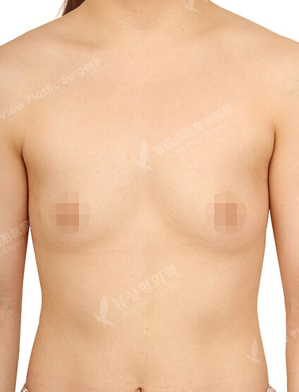 Breast Augmentation (6 Months) — Before