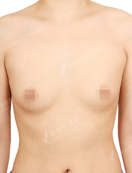 Breast Augmentation (7 Months) — Before