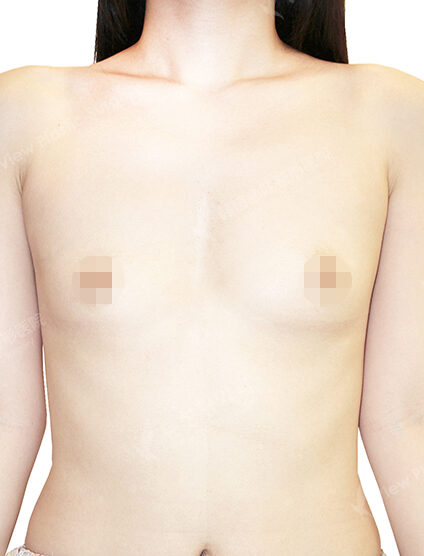 Breast Augmentation (4 Months) — Before