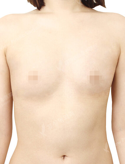 Breast Augmentation (6 Months) — Before