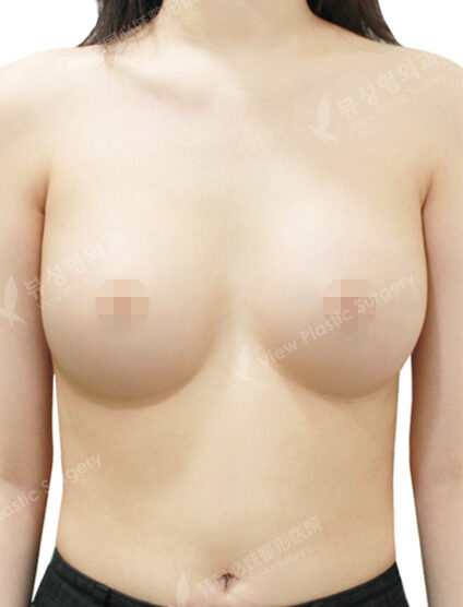 Breast Augmentation (6 Months) — After