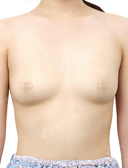 Breast Augmentation+Breast Accesorry removal (5 Months) — Before
