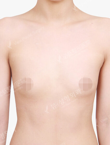 Breast Augmentation (5 Months) — Before