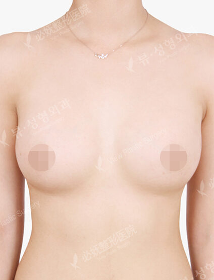 Breast Augmentation (5 Months) — After