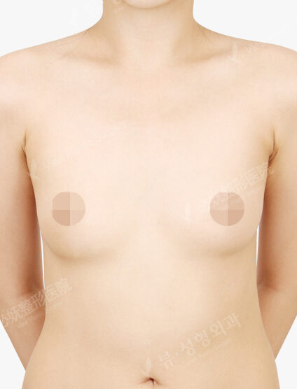 Breast Augmentation (5 Months) — Before