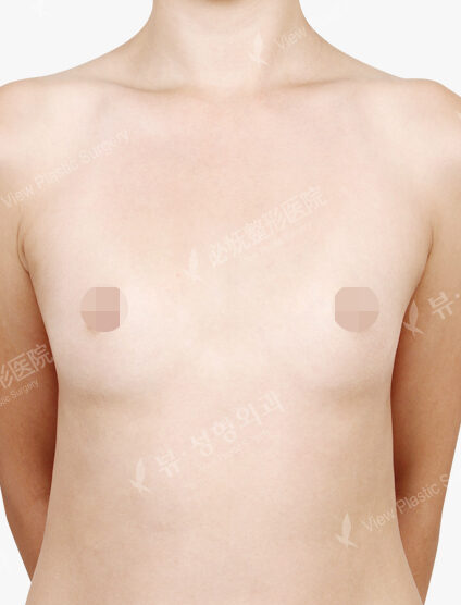 Breast Augmentation (10 Months) — Before