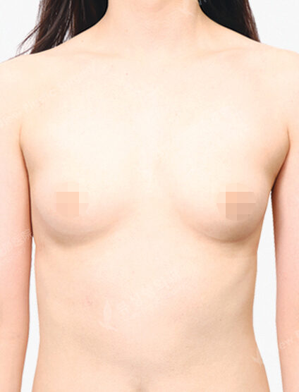 Motiva Breast Augmentation (3 Months) — Before
