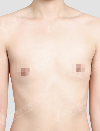 Motiva Breast Augmentation (4 Months) — Before