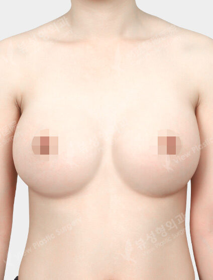Motiva Breast Augmentation (4 Months) — After