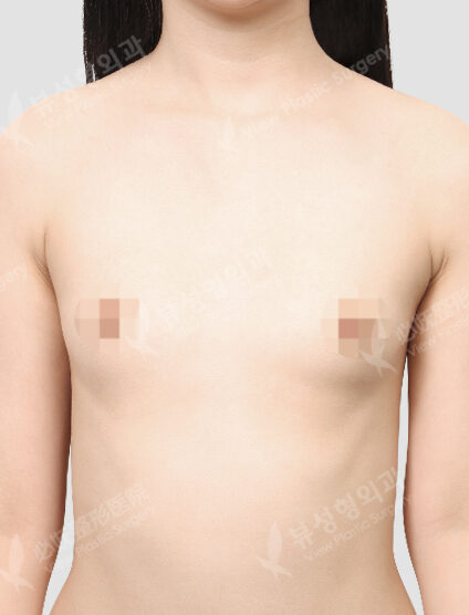Motiva Breast Augmentation (6 Months) — Before