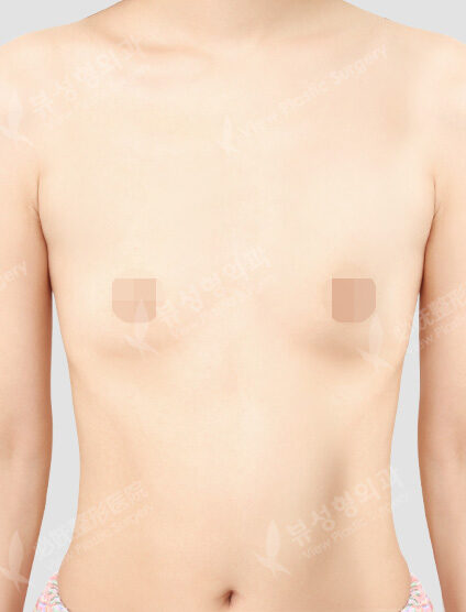 Breast Augmentation (6 Months) — Before