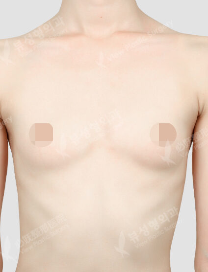 Breast Augmentation (Motiva)(3 Months) — Before