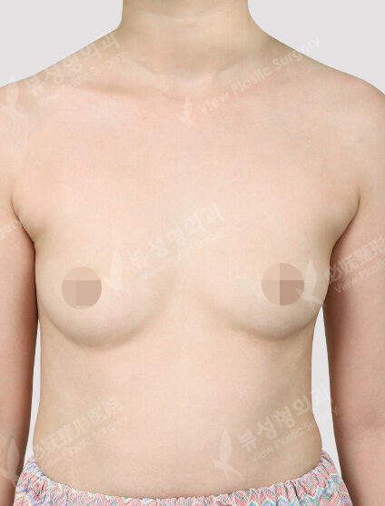 Breast Augmentation (Motiva)(4 Months) — Before