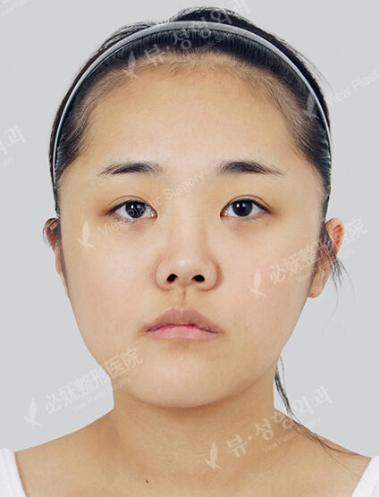Nano Two Jaw+Natural Vline+Zygoma Reduction (3 Months) — Before