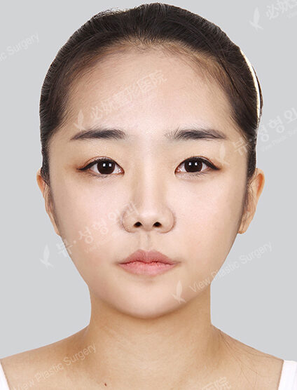 Nano Two Jaw+Natural Vline+Zygoma Reduction (3 Months) — After