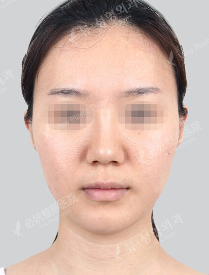 Two Jaw Surgery+Doll Line (Vline)+ Zygoma Reduction Surgery(4 Months) — Before