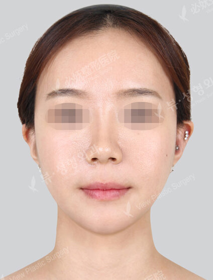 Two Jaw Surgery+Doll Line (Vline)+ Zygoma Reduction Surgery(4 Months) — After