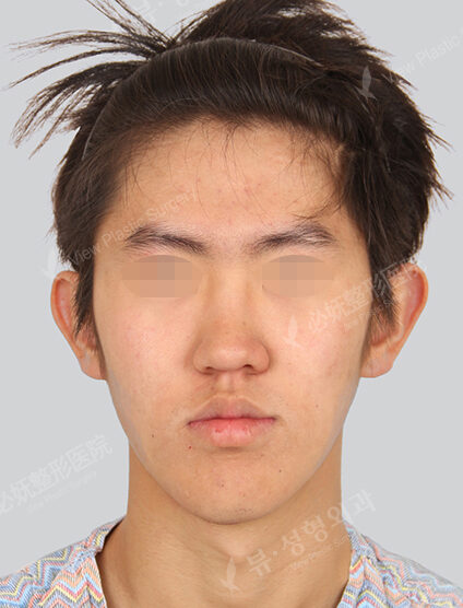 Two Jaw+Natural Vline+Forehead Implant (6 Months) — Before