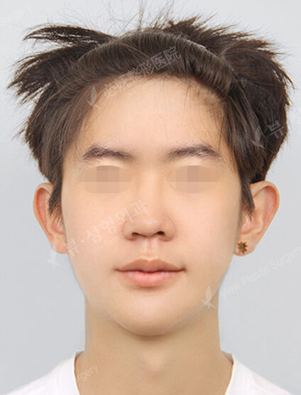 Two Jaw+Natural Vline+Forehead Implant (6 Months) — After