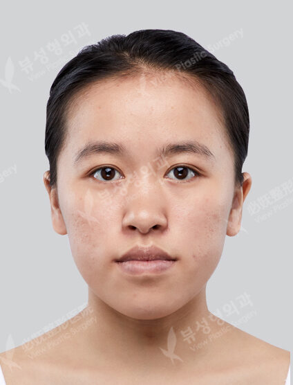Two Jaw Surgery+Angular Jaw Reduction+Zygoma Reduction+AdvanceGenioplasty (3 Months) — Before