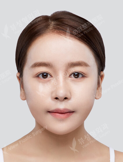 Two Jaw Surgery+Angular Jaw Reduction+Zygoma Reduction+AdvanceGenioplasty (3 Months) — After
