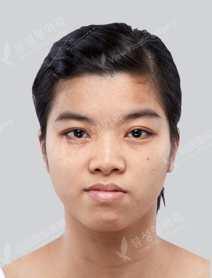 Two Jaw Surgery+Angular Jaw Reduction+Zygoma Reduction+T-Osteotomy (3 Months) — Before