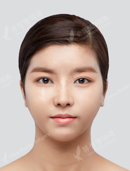 Two Jaw Surgery+Angular Jaw Reduction+Zygoma Reduction+T-Osteotomy (3 Months) — After