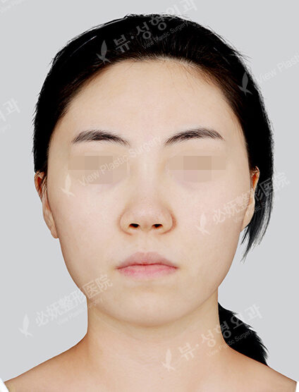 Protruding Mouth+Natural Vline+Zygoma Reduction+Forehead Implant+Rhinoplasty (2 Months) — Before
