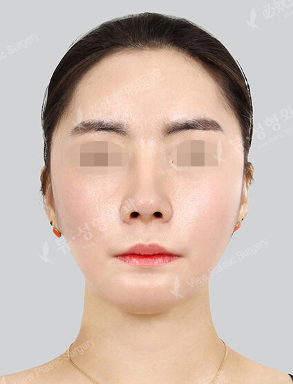 Protruding Mouth+Natural Vline+Zygoma Reduction+Forehead Implant+Rhinoplasty (2 Months) — After