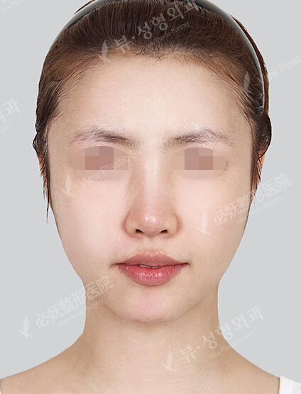 Nano Two Jaw+Natural Vline+Zygoma Reduction (Revisional Surgery)+ Acculifting (Cheeks , ChinLine) (4 Months) — Before