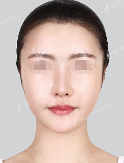 Nano Two Jaw+Natural Vline+Zygoma Reduction (Revisional Surgery)+ Acculifting (Cheeks , ChinLine) (4 Months) — After