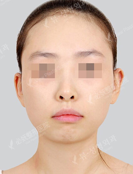 Protruding Mouth+Doll Line (Vline)+ Zygoma Reduction (1 Months) — Before