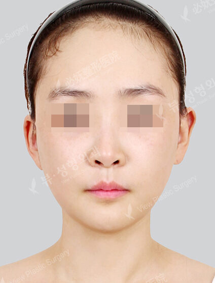 Protruding Mouth+Doll Line (Vline)+ Zygoma Reduction (1 Months) — After