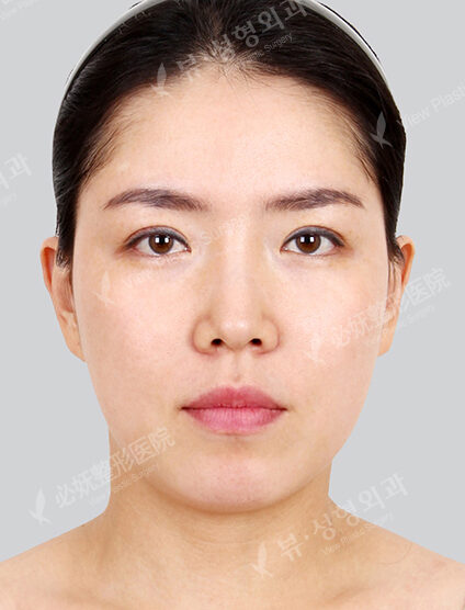 Nano Two Jaw+Natural Vline (2 Months) — Before