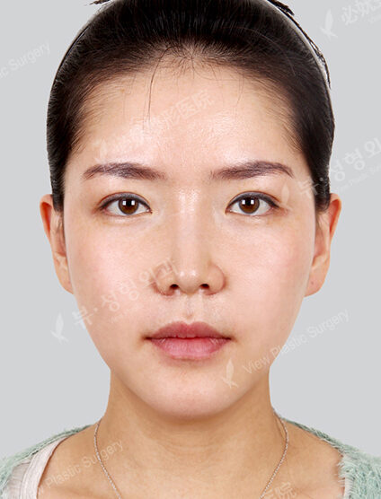 Nano Two Jaw+Natural Vline (2 Months) — After