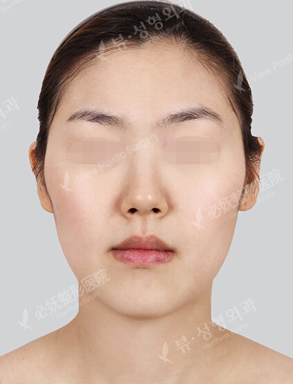 Nano Two Jaw+Natural Vline+Zygoma Reduction)(7 Months) — Before