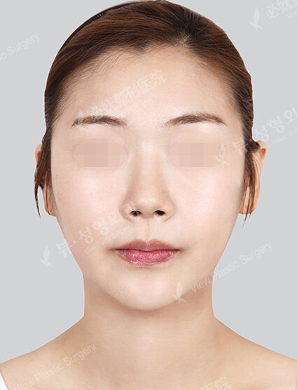 Nano Two Jaw+Natural Vline+Zygoma Reduction)(7 Months) — After